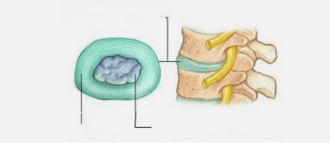Osteokondroosi olemus